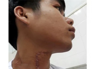 Nam thanh niên bị trâu nhà hàng xóm húc thủng cổ, rách khí quản