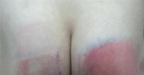 Không làm bài tập về nhà, bé gái 8 tuổi bị đánh bầm mông