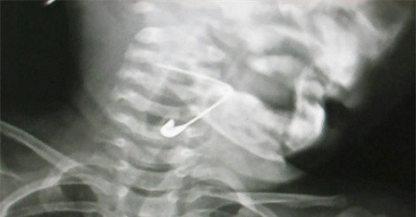 Cứu sống bé gái 18 tháng tuổi nuốt kim băng vào thanh quản