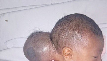 Cứu sống bé sơ sinh "2 đầu" bị bỏ rơi