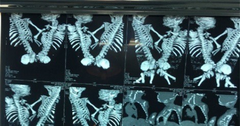 Mổ tách thành công cặp song sinh dính nhau khi vừa chào đời