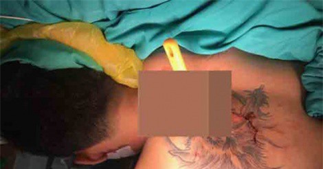 Thanh niên xăm trổ bị bạn gái đâm nguy kịch