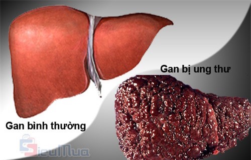 Dấu hiệu phát hiện tiền ung thư gan và những bước tiến quan trọng của ngành y