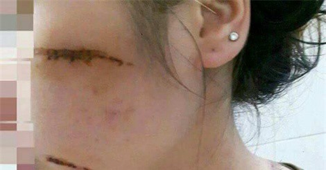 Nhóm côn đồ chém trọng thương nữ nhân viên spa