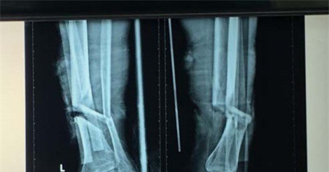 Đi cắt cỏ, cụ ông bị máy cắt gần lìa chân trái