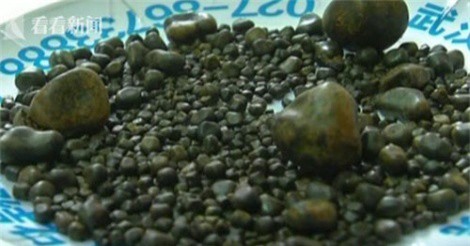 Bà cụ có hơn 800 viên sỏi trong túi mật vì thói quen ăn thịt mỡ