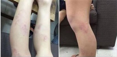 Sốc: 11 học sinh lớp 2 ở Hà Nội bị giáo viên quật bầm tím chân