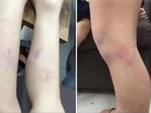 Sốc: 11 học sinh lớp 2 ở Hà Nội bị giáo viên quật bầm tím chân