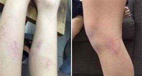 Tạm đình chỉ giáo viên đánh 11 học sinh tiểu học Nguyễn Tri Phương