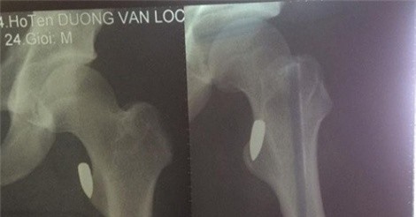 Đang đi trên đường, 1 VĐV Pencak silat bất ngờ bị trúng đạn