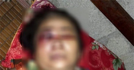 Truy tìm thanh niên hành hung cụ bà 65 tuổi hỏng một con mắt