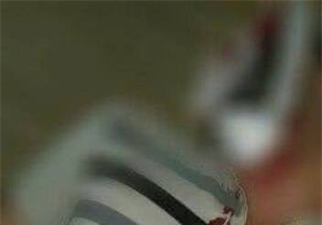 Hòa Bình: Nam thanh niên nghi bị "đạn lạc' rơi trúng cổ, phải nhập viện