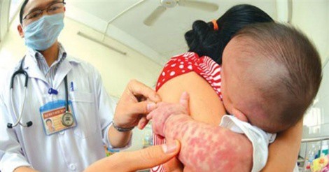 H&#xE0; N&#x1ED9;i: B&#x1EC7;nh s&#x1EDF;i &#x111;ang c&#xF3; d&#x1EA5;u hi&#x1EC7;u gia t&#x103;ng