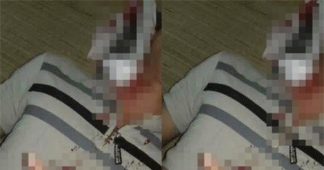 Tình tiết mới vụ thanh niên nghi bị "đạn lạc" găm trúng cổ ở Hòa Bình