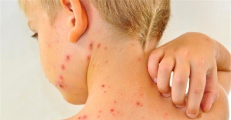 Bệnh sởi có thể bùng phát thành dịch 