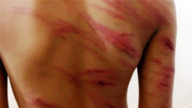 Trà Vinh: Tạm giam cha dượng bạo hành cháu bé 8 tuổi