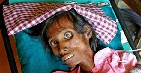 Những nỗ lực để chấm dứt nạn HIV - AIDS trên toàn cầu