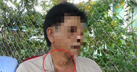 Nuốt lưỡi cưa, ảo thuật gia suýt chết vì thủng thực quản