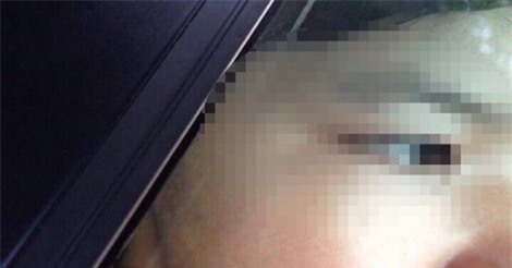 Bé gái 7 tuổi nghi bị cha ruột, mẹ kế dí sắt nung nóng vào mặt