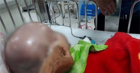 Thanh Hóa: Bé trai 13 tháng tuổi bị não úng thủy tử vong