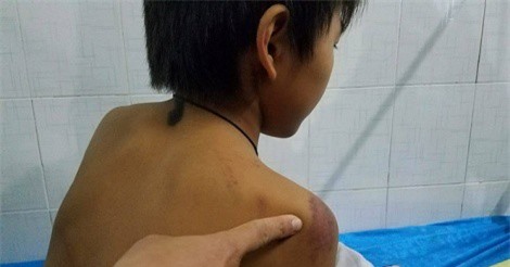 Đắk Lắk: Triệu tập người cha đánh con trai 11 tuổi đến nhập viện