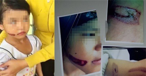 Cách ly với bé gái 7 tuổi nghi bị cha dí sắt vào mặt: Cha và mẹ kế vẫn đưa đi ăn uống?