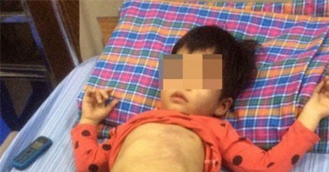 Bé 4 tuổi bị bạo hành trong lớp: Cô giáo nói bị bạn quây, bé “tố” bị các cô đánh