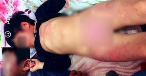 Bé gái 4 tuổi bị bầm tím hết người sau khi đi học về