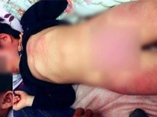 Bé gái 4 tuổi bị bầm tím hết người sau khi đi học về