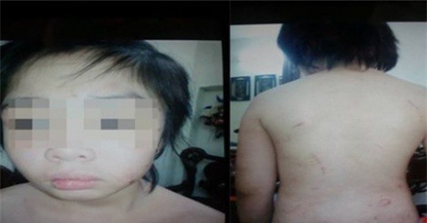 Bé trai 10 tuổi bị bố và mẹ kế bạo hành phải theo dõi chấn thương sọ não
