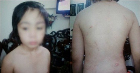 Cư dân mạng phẫn nộ vụ bé trai 10 tuổi bị bố và mẹ kế bạo hành