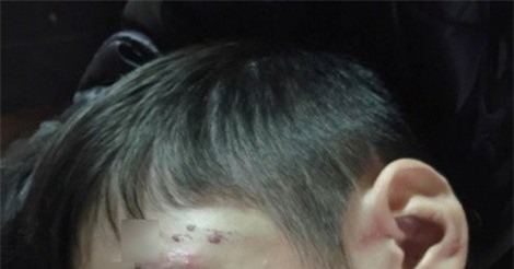Xót xa những “dấu vết” bị cha bạo hành trên người cậu bé 10 tuổi