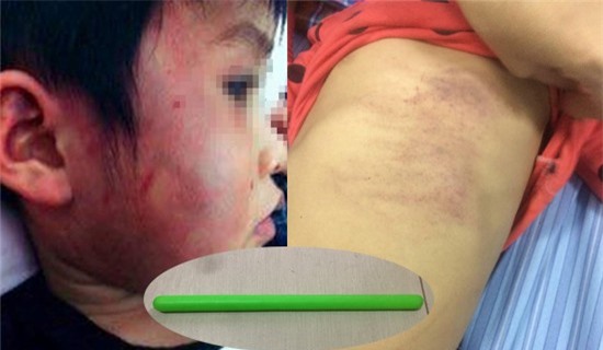 Vụ bé 4 tuổi bị bầm tím tại lớp: Kỷ luật hiệu trưởng và giáo viên