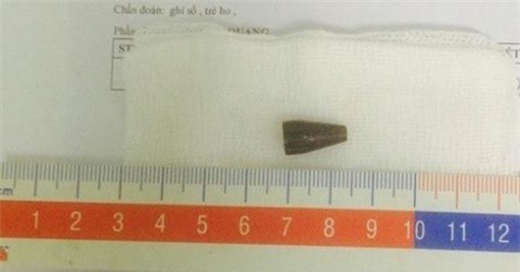 Mối nguy hiểm đến từ thói quen ngậm bút bi