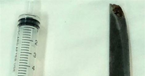 Chàng trai không biết lưỡi dao nhiều năm nằm trong lưng mình