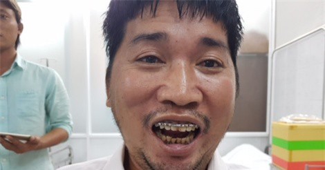 Phẫu thuật thành công ca bệnh dính khớp thái dương hàm