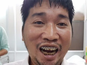 Phẫu thuật thành công ca bệnh dính khớp thái dương hàm