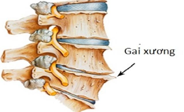 Những sai lầm "chết người" trong điều trị gai cột sống