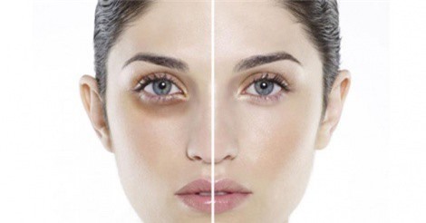 Clip: Mẹo trị quầng thâm mắt bằng những nguyên liệu có sẵn trong bếp