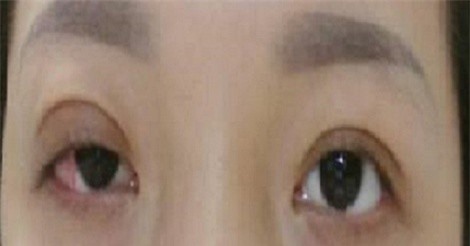 Phẫu thuật thẩm mỹ giá rẻ, cô gái bị biến chứng liệt cơ mí vĩnh viễn