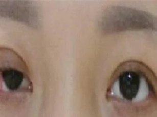 Phẫu thuật thẩm mỹ giá rẻ, cô gái bị biến chứng liệt cơ mí vĩnh viễn