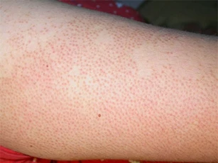 Clip: 7 mẹo hay trị dứt điểm viêm lỗ chân lông ngay tại nhà