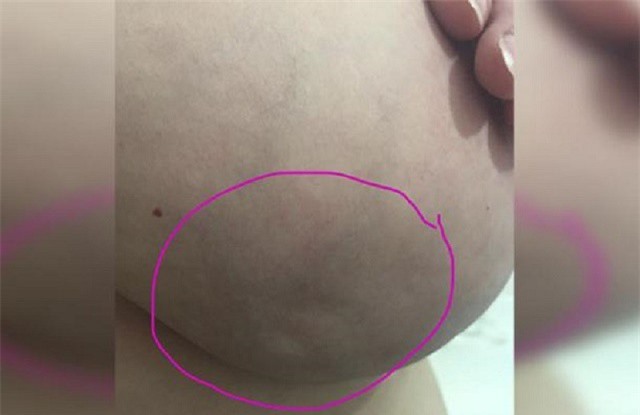 Vết lõm ở ngực cảnh báo ung thư vú