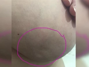 Vết lõm ở ngực cảnh báo ung thư vú