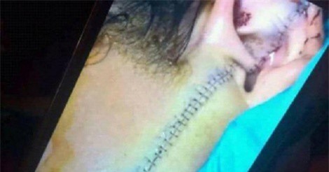 Thanh Hóa: Khởi tố vụ nữ sinh bị rạch mặt ở chợ