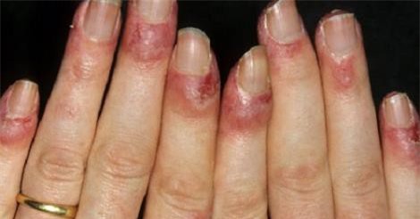 Đề phòng bệnh cước chân tay mùa rét