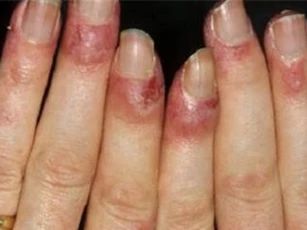 Đề phòng bệnh cước chân tay mùa rét