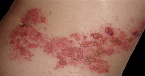 Giời leo - bệnh tưởng đơn giản có thể gây biến chứng khó lường