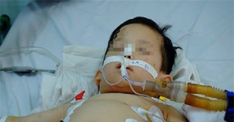 Thương tâm bé trai 1 tuổi gặp nguy kịch vì bị chó nhà cắn nát mặt