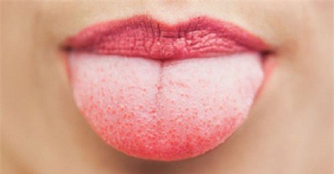 Triệu chứng cảnh báo ung thư lưỡi dễ nhầm lẫn với nhiệt miệng